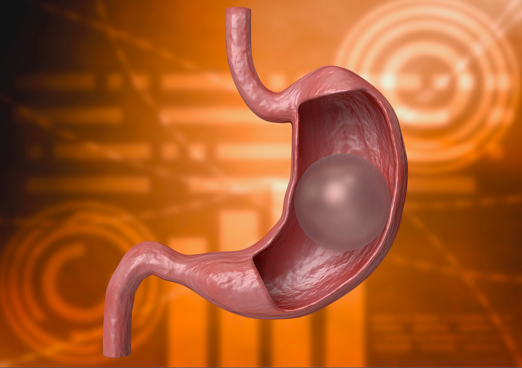 Advanced Gastric Bypass Surgery In Istanbul