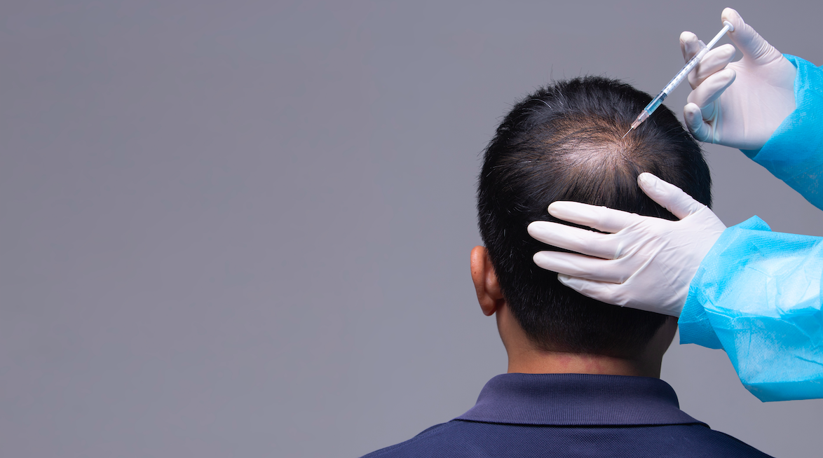 When is The Best Time For Hair Transplant in Istanbul?