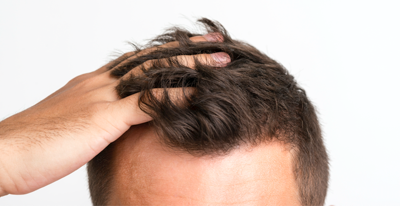 Top Hair Transplant Types In Istanbul