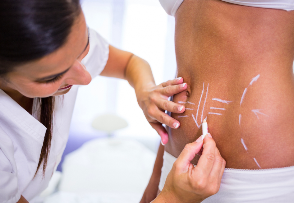 Liposuction Surgery in Istanbul