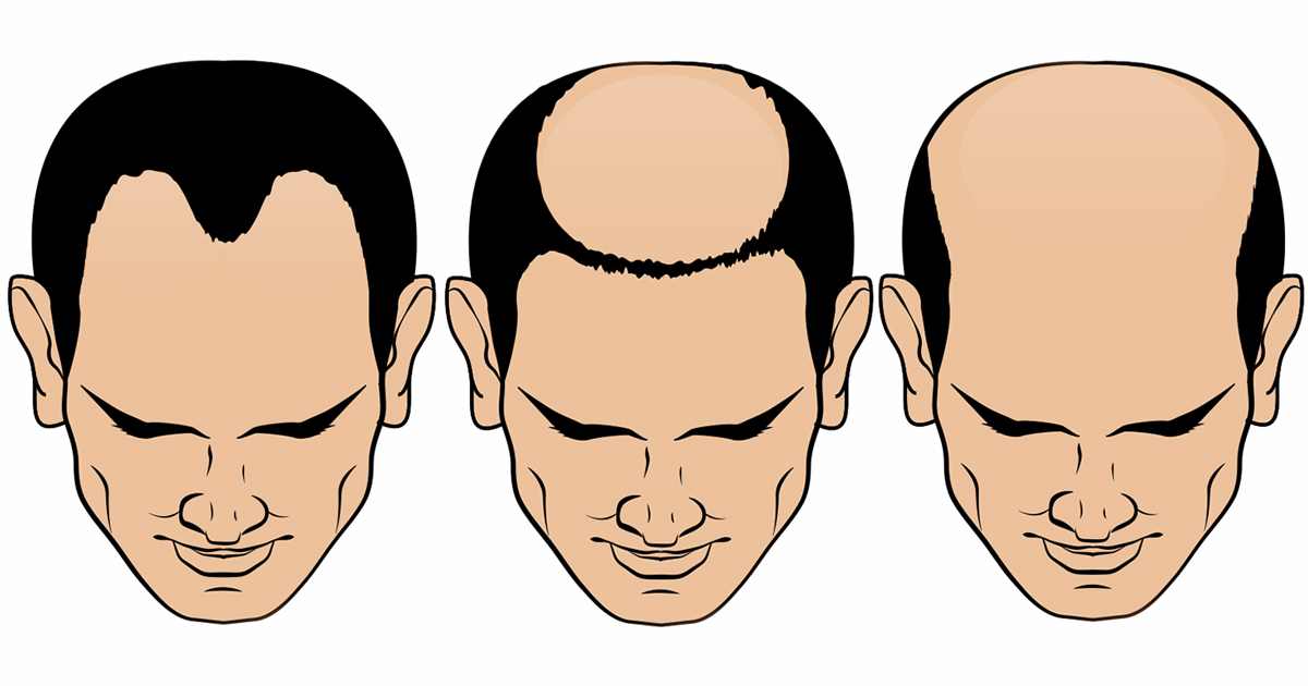 Best Hair Transplant Options in Istanbul