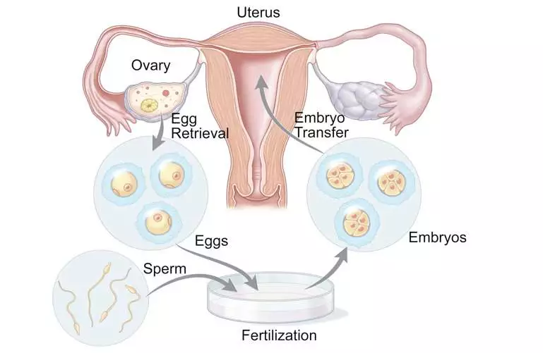 Fertility Operation in Istanbul
