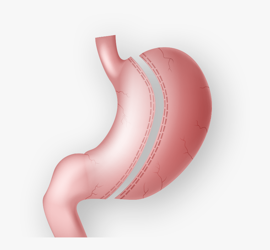 Istanbul’s Gastric Bypass Options