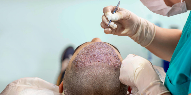 Hair Transplant Operation in Istanbul